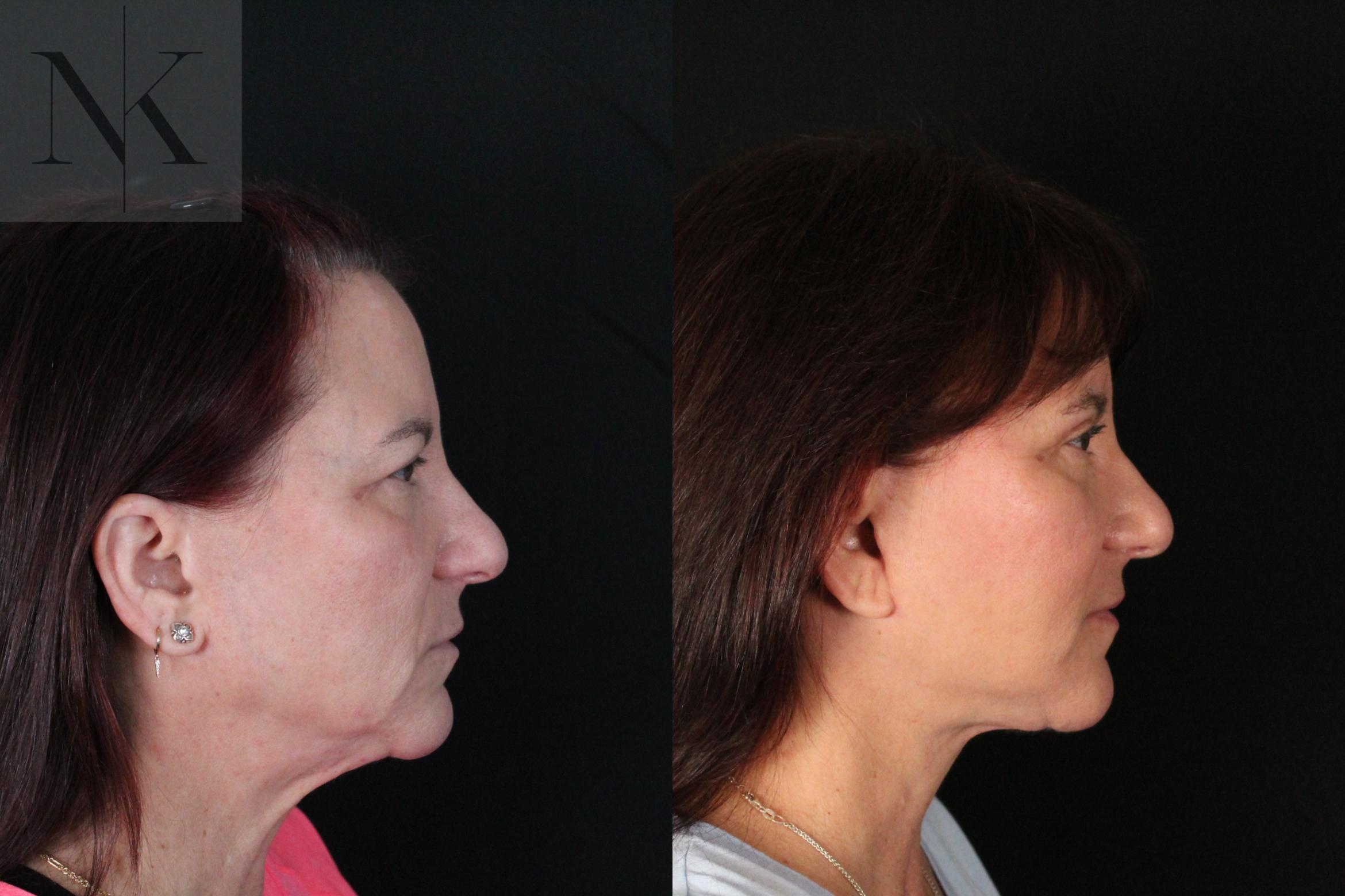 Before & After Deep Plane Facelift Case 218 Right Side View in Wethersfield, Hartford, Nebraska