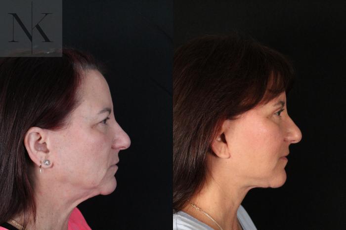 Before & After Deep Plane Facelift Case 218 Right Side View in Wethersfield, Hartford, Nebraska