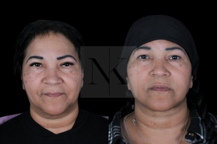 Before & After Deep Neck Sculpting Case 3 Front View in Wethersfield, Hartford, Nebraska