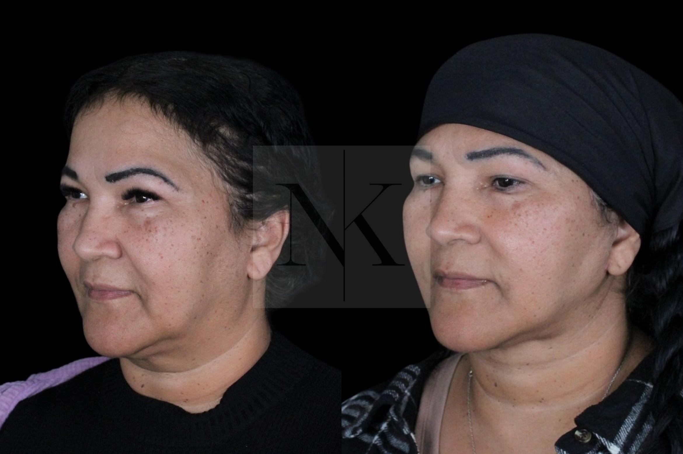 Before & After Deep Neck Sculpting Case 3 Left Oblique View in Wethersfield, Hartford, Nebraska