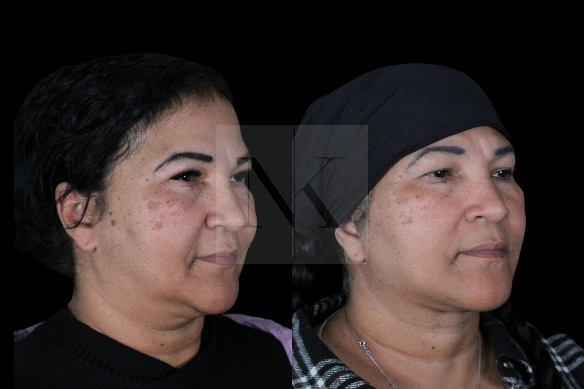 Before & After Deep Neck Sculpting Case 3 Right Oblique View in Wethersfield, Hartford, Nebraska