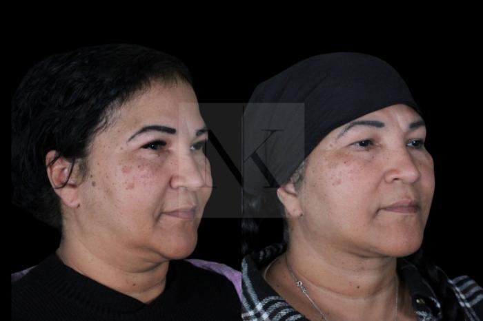 Before & After Deep Neck Sculpting Case 3 Right Oblique View in Wethersfield, Hartford, Nebraska