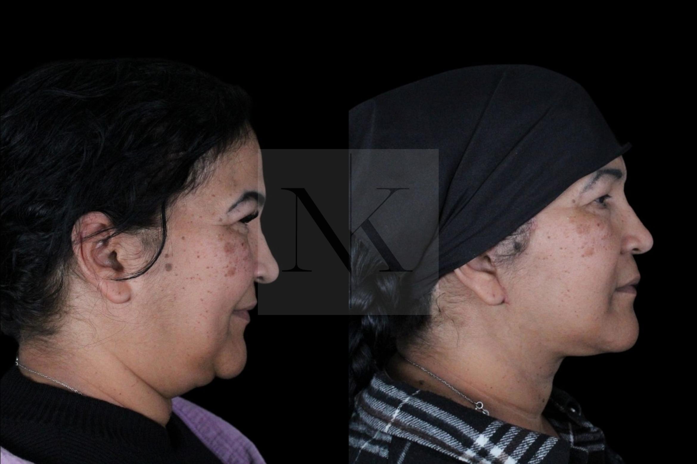 Before & After Deep Neck Sculpting Case 3 Right Side View in Wethersfield, Hartford, Nebraska