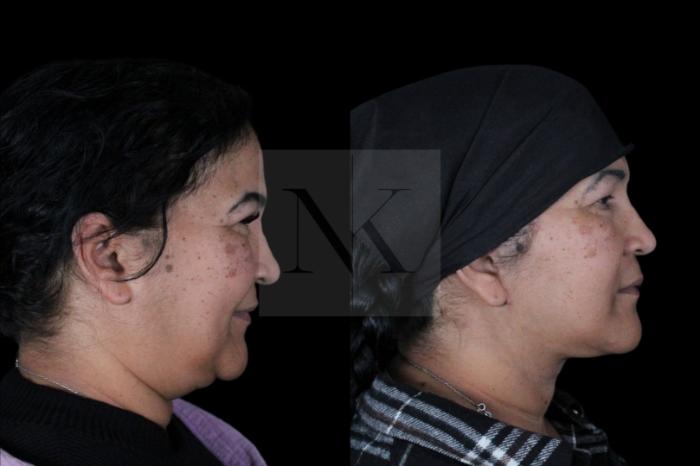Before & After Deep Neck Sculpting Case 3 Right Side View in Wethersfield, Hartford, Nebraska