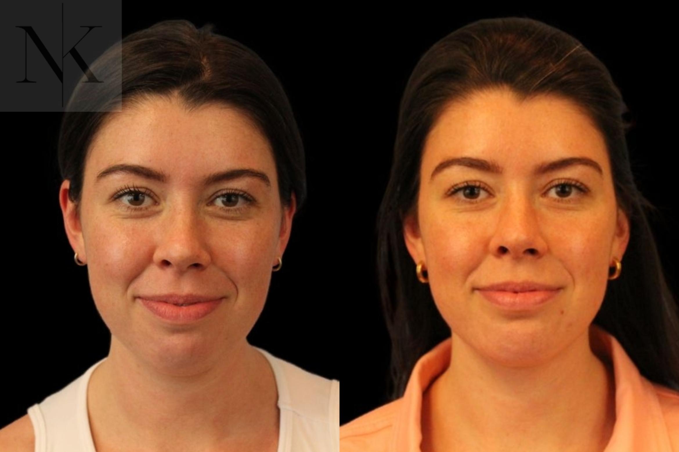 Before & After Isolated Deep Neck Lift Case 113 Front View in Wethersfield, Hartford, Nebraska