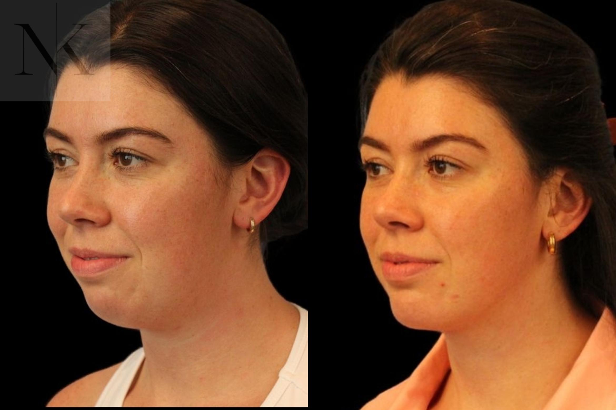 Before & After Isolated Deep Neck Lift Case 113 Left Oblique View in Wethersfield, Hartford, Nebraska