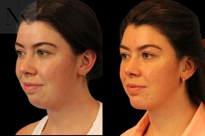 Before & After Isolated Deep Neck Lift Case 113 Left Oblique View in Wethersfield, Hartford, Nebraska