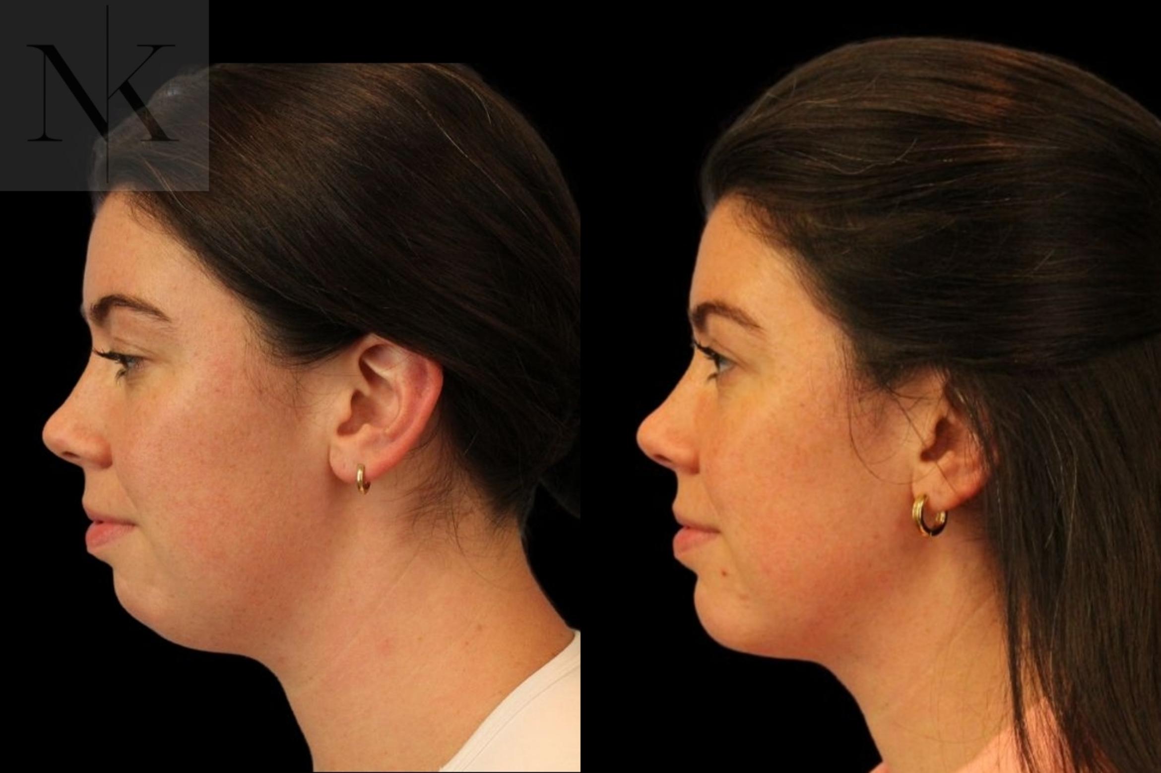 Before & After Isolated Deep Neck Lift Case 113 Left Side View in Wethersfield, Hartford, Nebraska