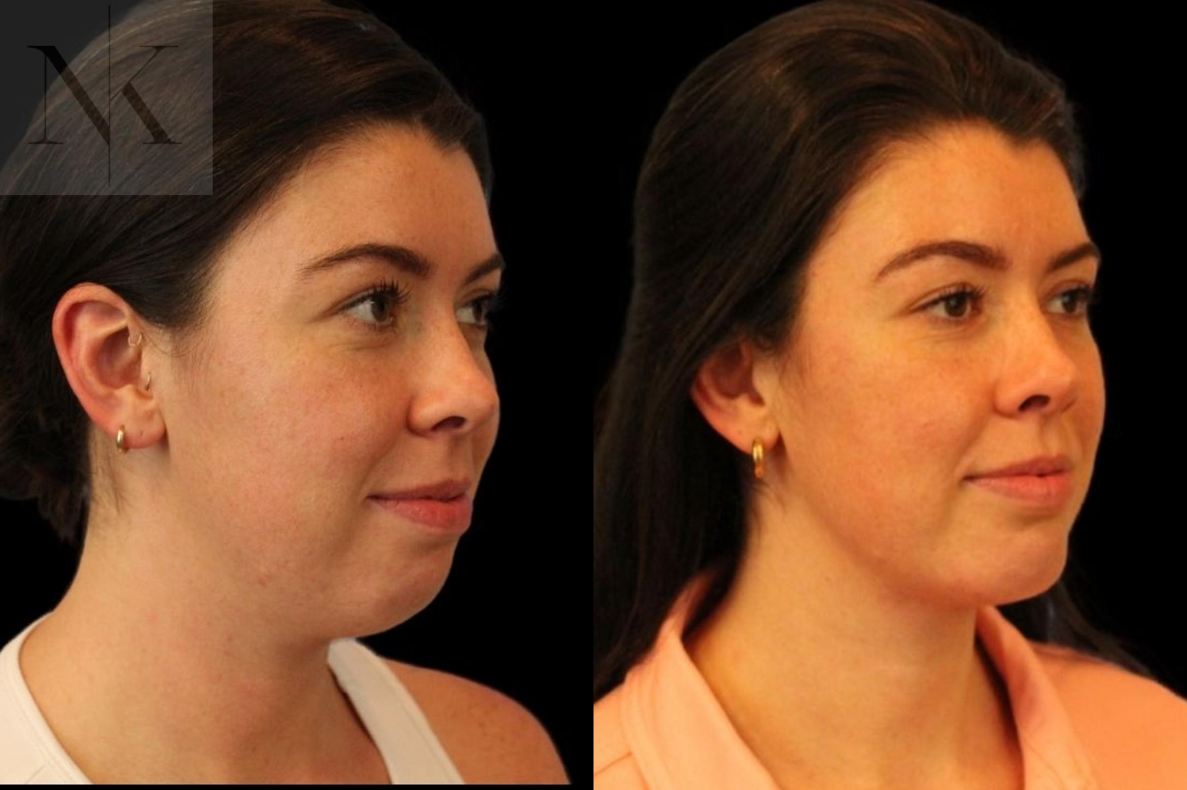 Before & After Isolated Deep Neck Lift Case 113 Right Oblique View in Wethersfield, Hartford, Nebraska