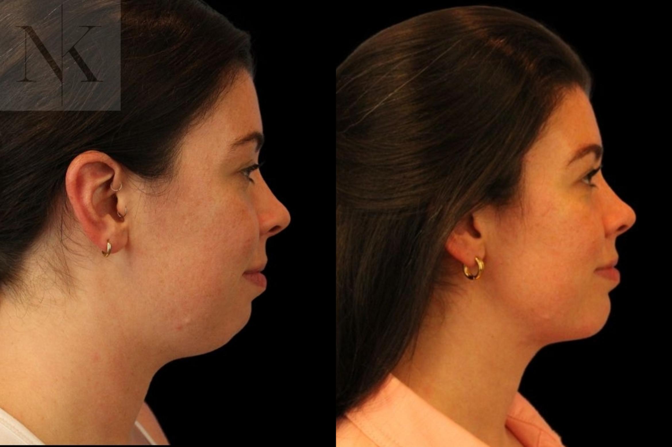 Before & After Isolated Deep Neck Lift Case 113 Right Side View in Wethersfield, Hartford, Nebraska