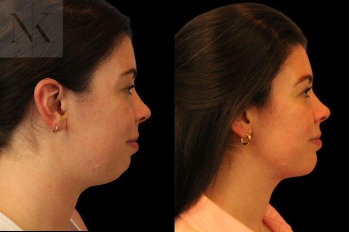 Before & After Isolated Deep Neck Lift Case 113 Right Side View in Wethersfield, Hartford, Nebraska