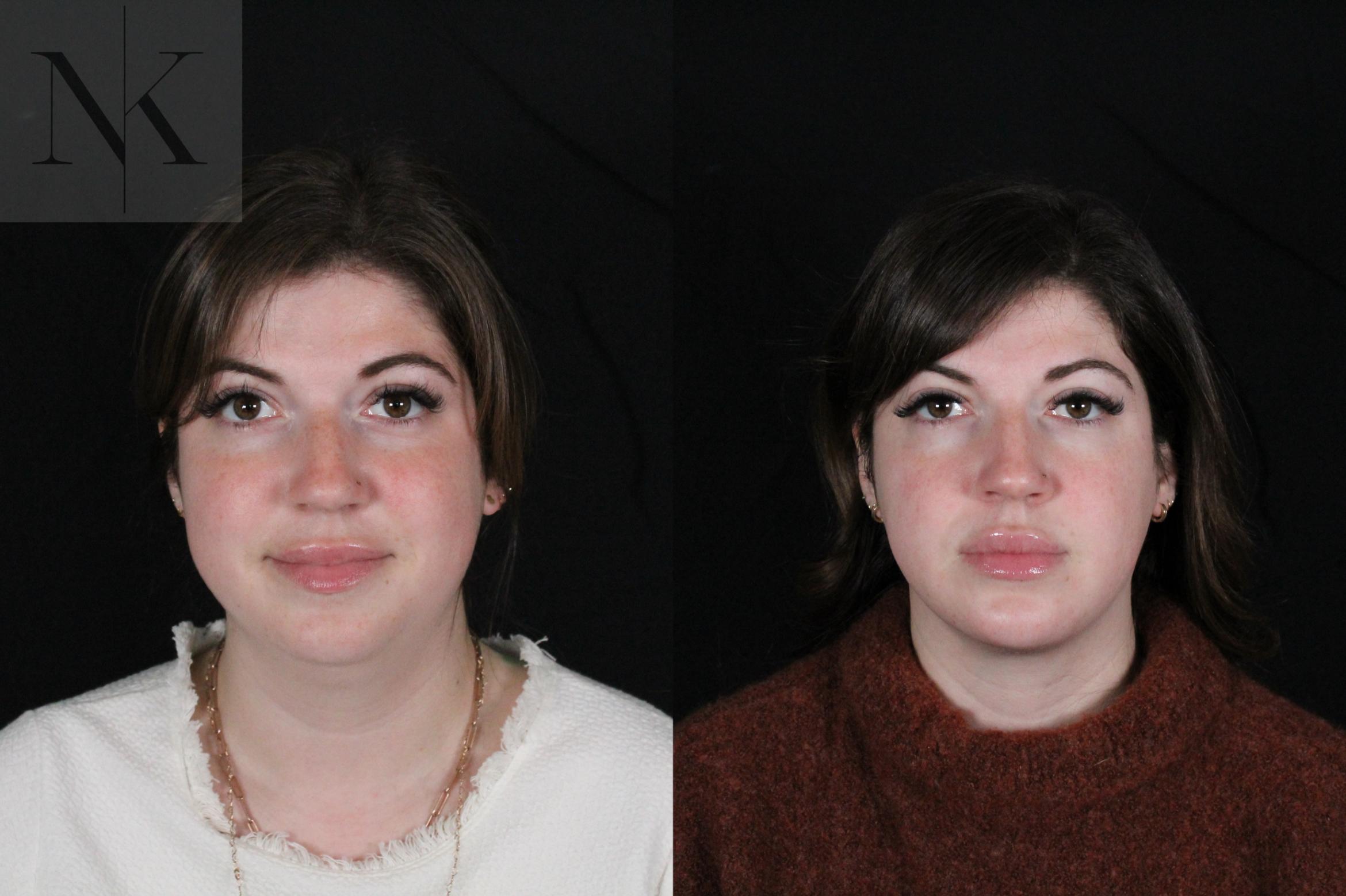 Before & After Isolated Deep Neck Lift Case 115 Front View in Wethersfield, Hartford, Nebraska