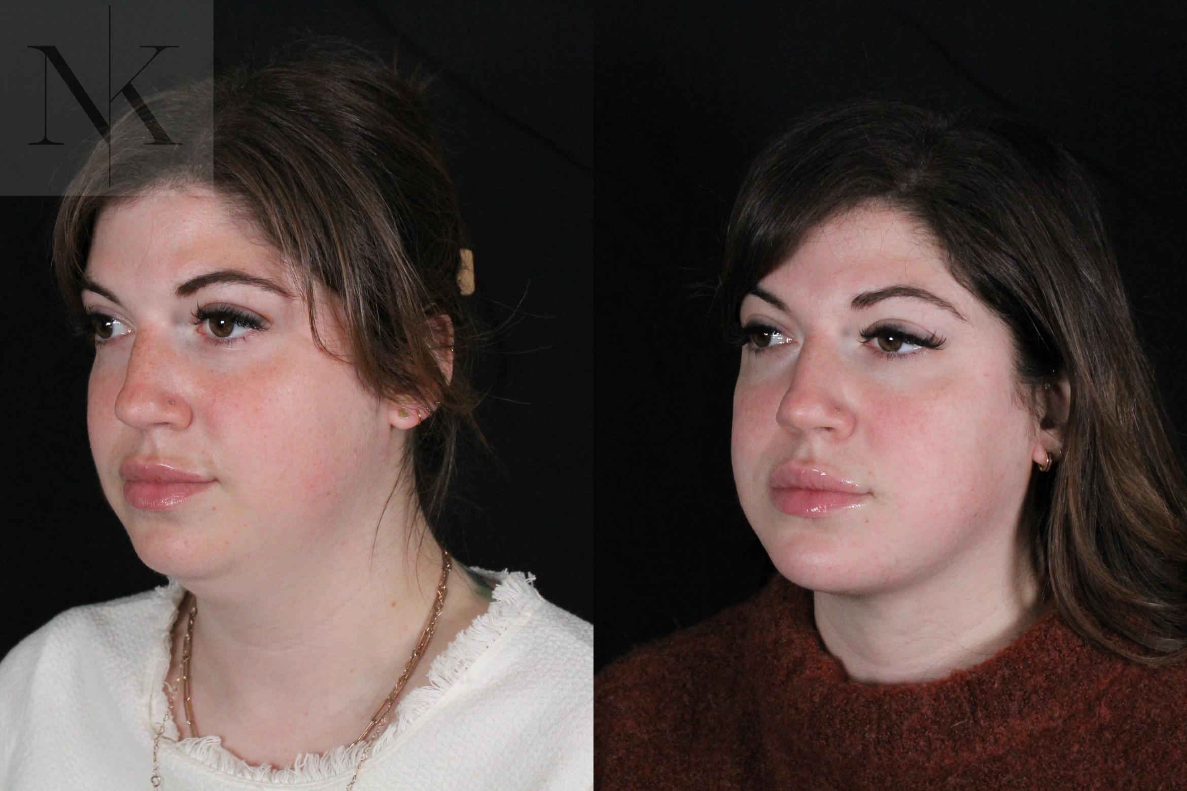 Before & After Isolated Deep Neck Lift Case 115 Left Oblique View in Wethersfield, Hartford, Nebraska