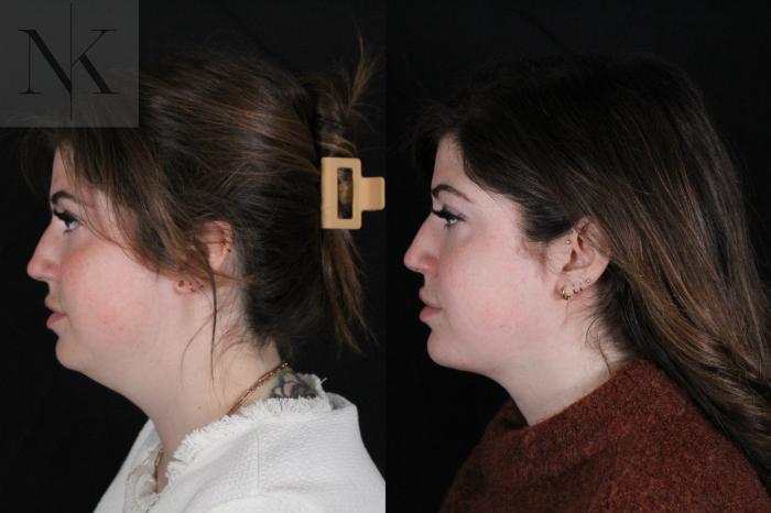 Before & After Isolated Deep Neck Lift Case 115 Left Side View in Wethersfield, Hartford, Nebraska