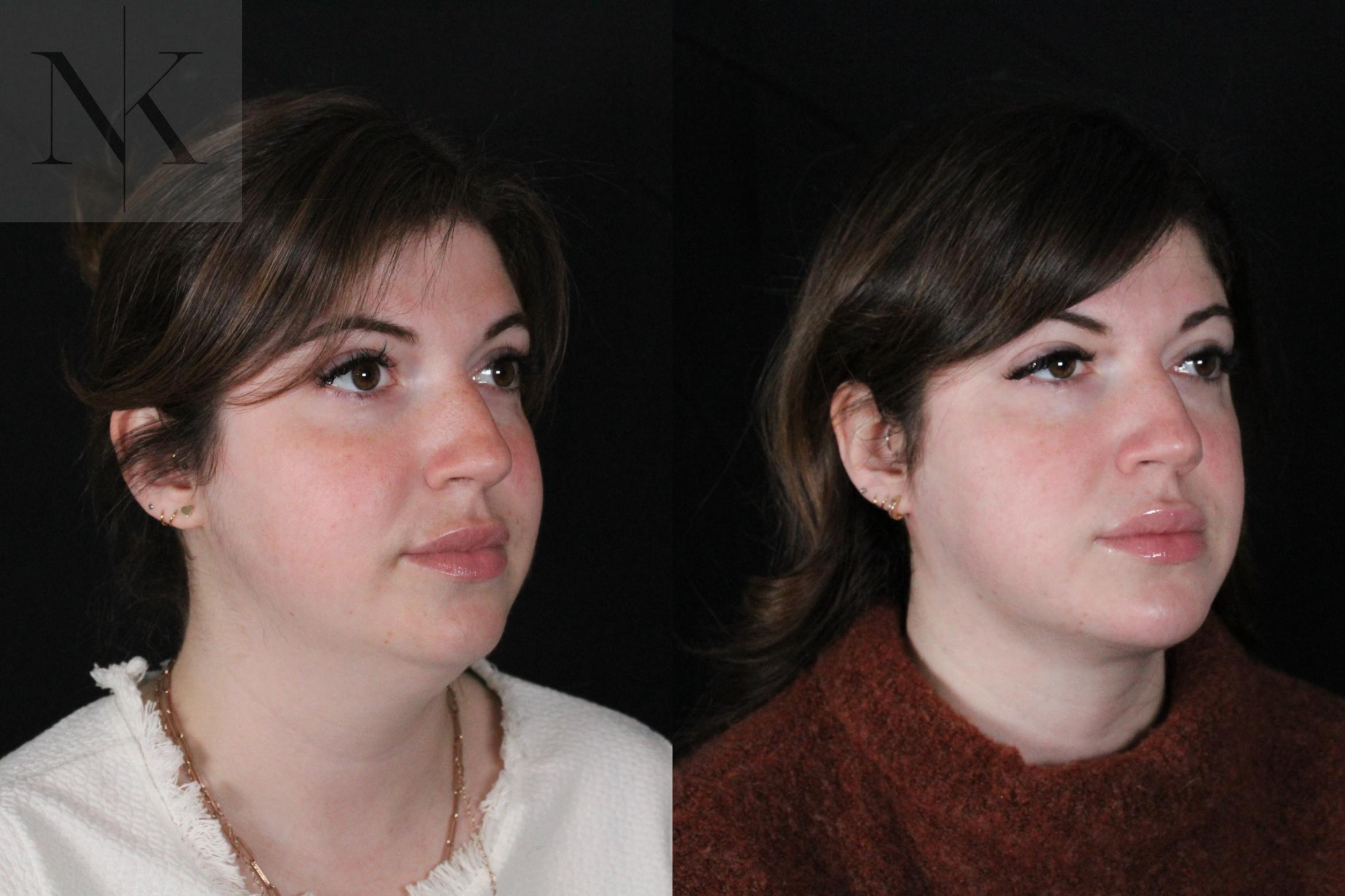 Before & After Isolated Deep Neck Lift Case 115 Right Oblique View in Wethersfield, Hartford, Nebraska