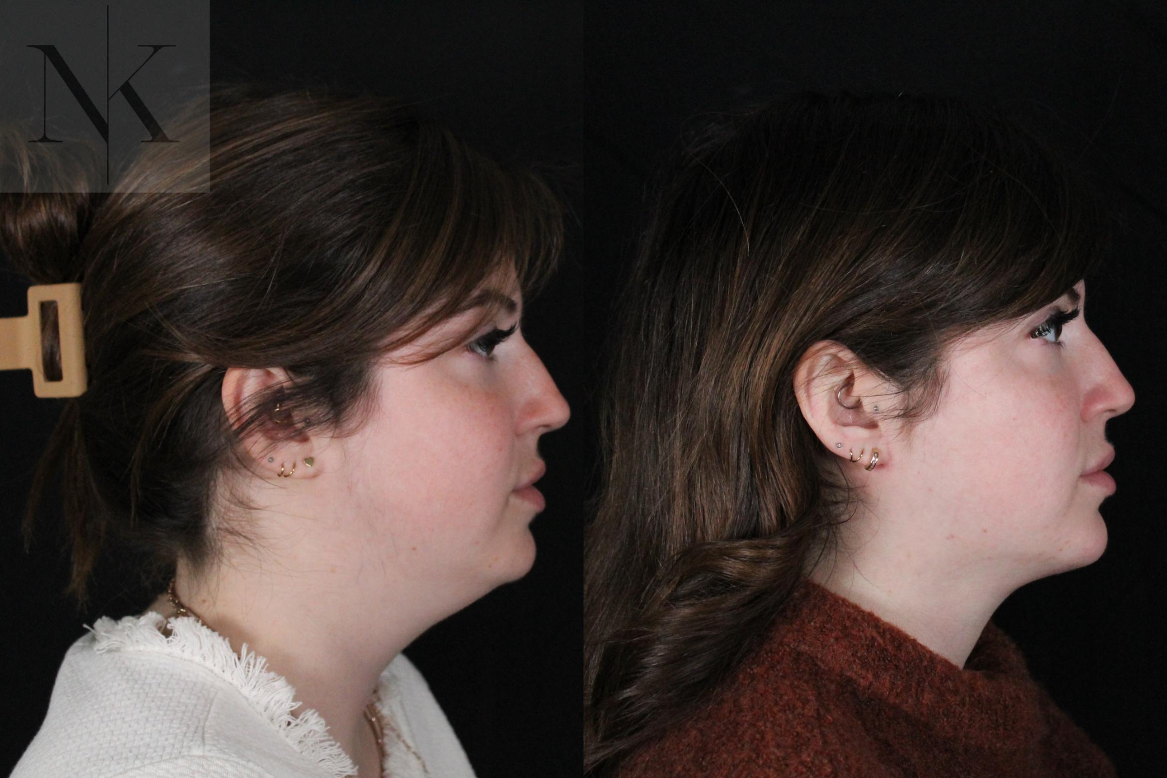 Before & After Isolated Deep Neck Lift Case 115 Right Side View in Wethersfield, Hartford, Nebraska