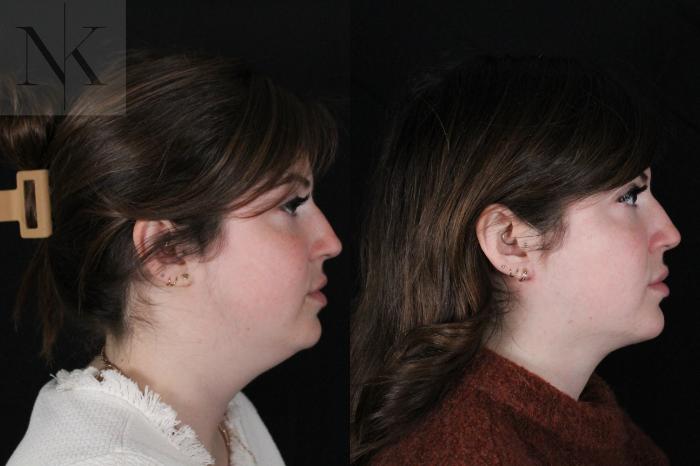 Before & After Isolated Deep Neck Lift Case 115 Right Side View in Wethersfield, Hartford, Nebraska