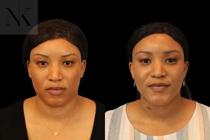 Before & After Isolated Deep Neck Lift Case 116 Front View in Wethersfield, Hartford, Nebraska