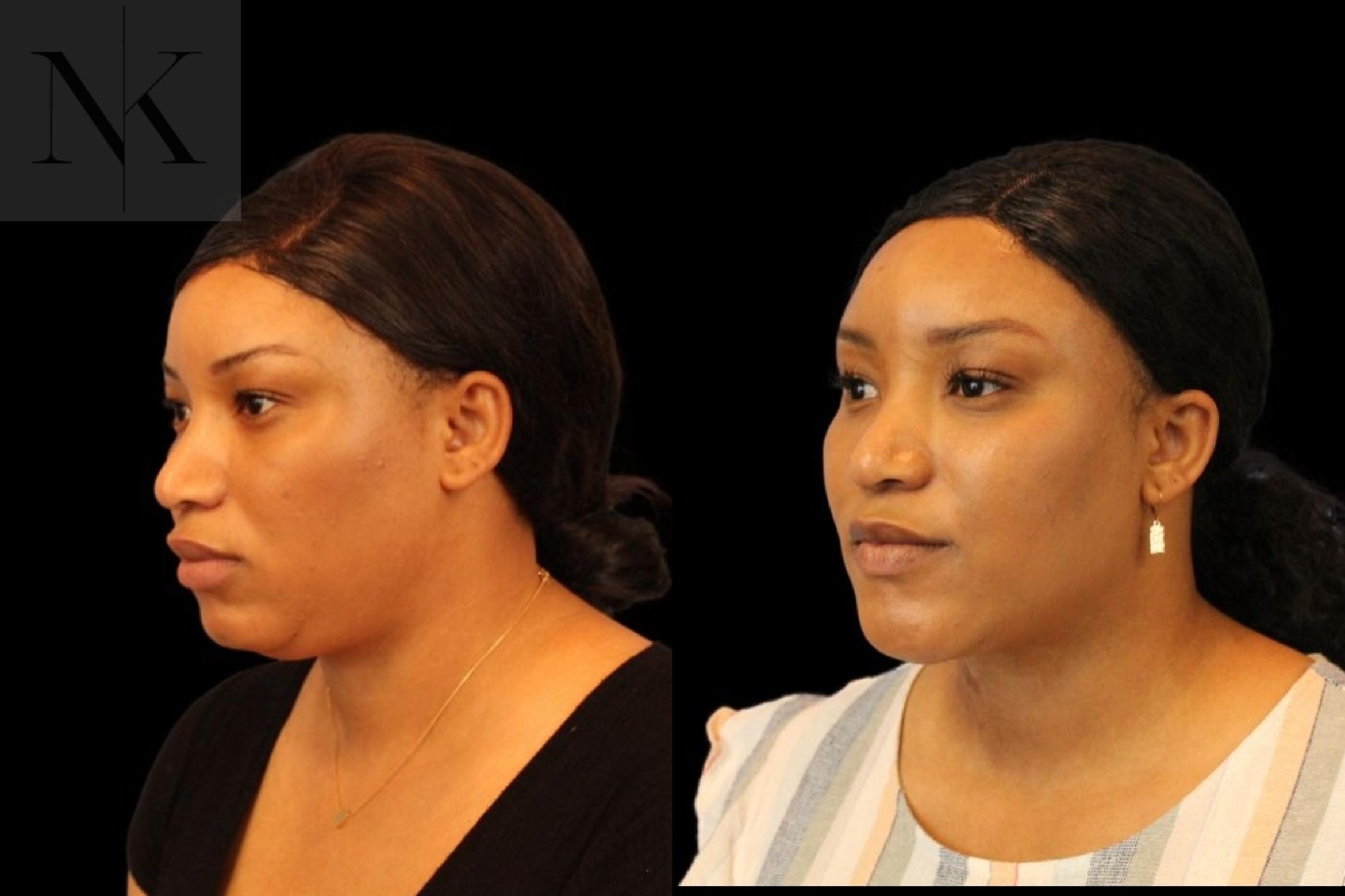 Before & After Isolated Deep Neck Lift Case 116 Left Oblique View in Wethersfield, Hartford, Nebraska