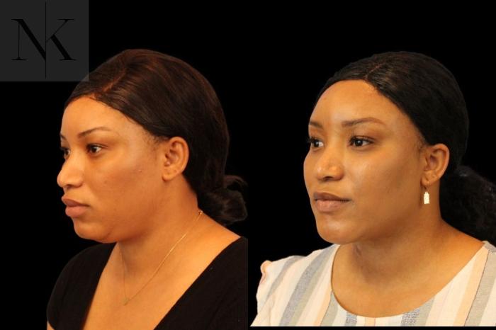 Before & After Isolated Deep Neck Lift Case 116 Left Oblique View in Wethersfield, Hartford, Nebraska