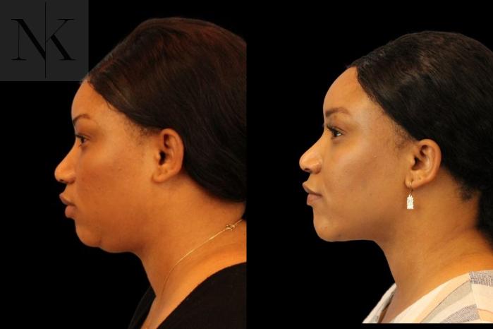 Before & After Isolated Deep Neck Lift Case 116 Left Side View in Wethersfield, Hartford, Nebraska