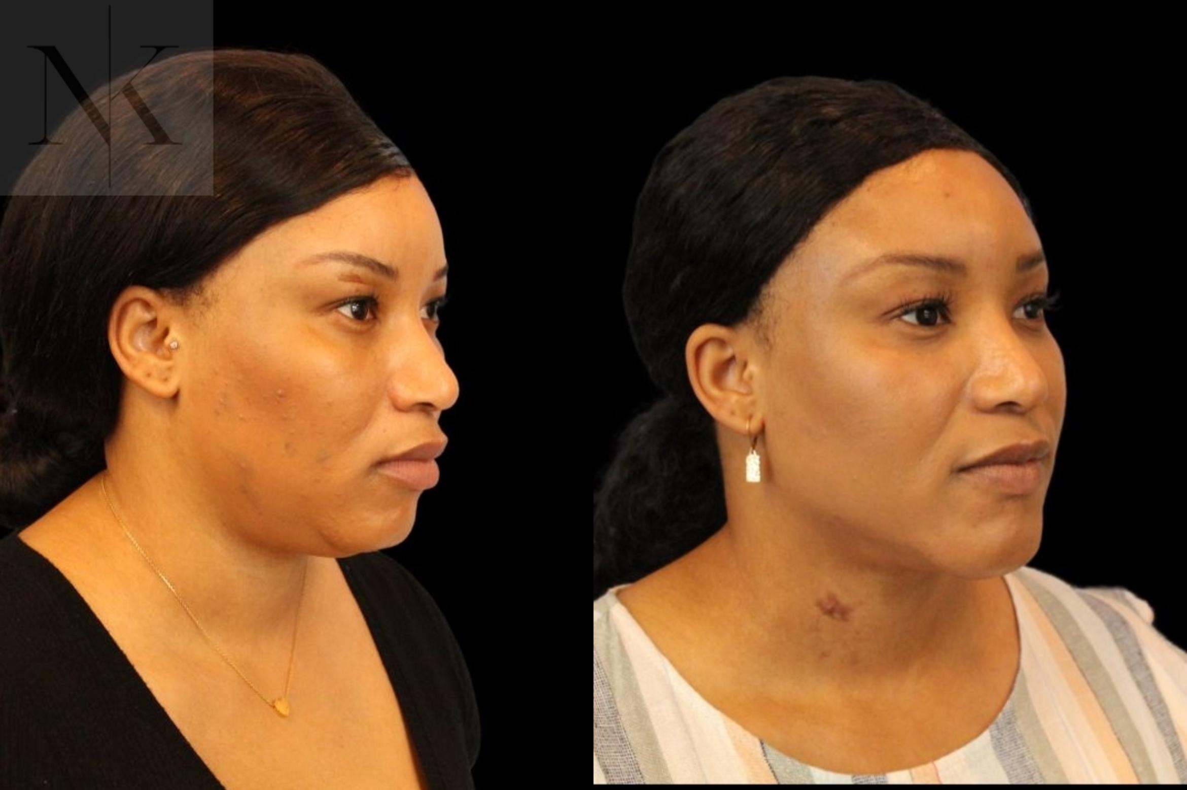 Before & After Isolated Deep Neck Lift Case 116 Right Oblique View in Wethersfield, Hartford, Nebraska