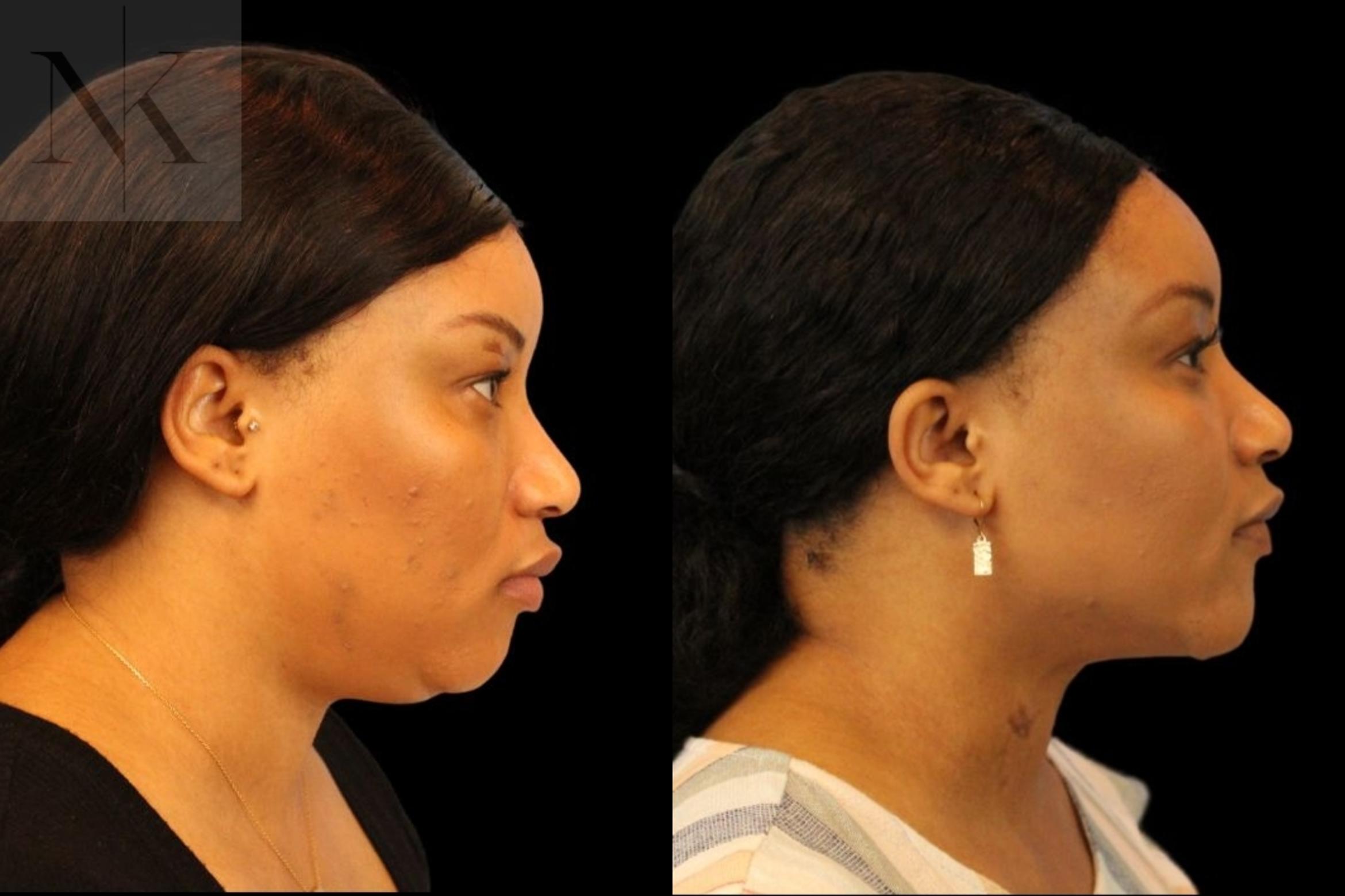 Before & After Isolated Deep Neck Lift Case 116 Right Side View in Wethersfield, Hartford, Nebraska