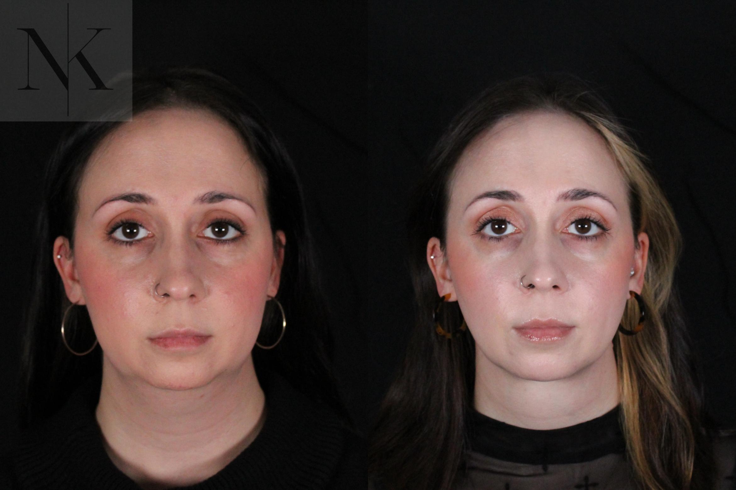 Before & After Isolated Deep Neck Lift Case 117 Front View in Wethersfield, Hartford, Nebraska