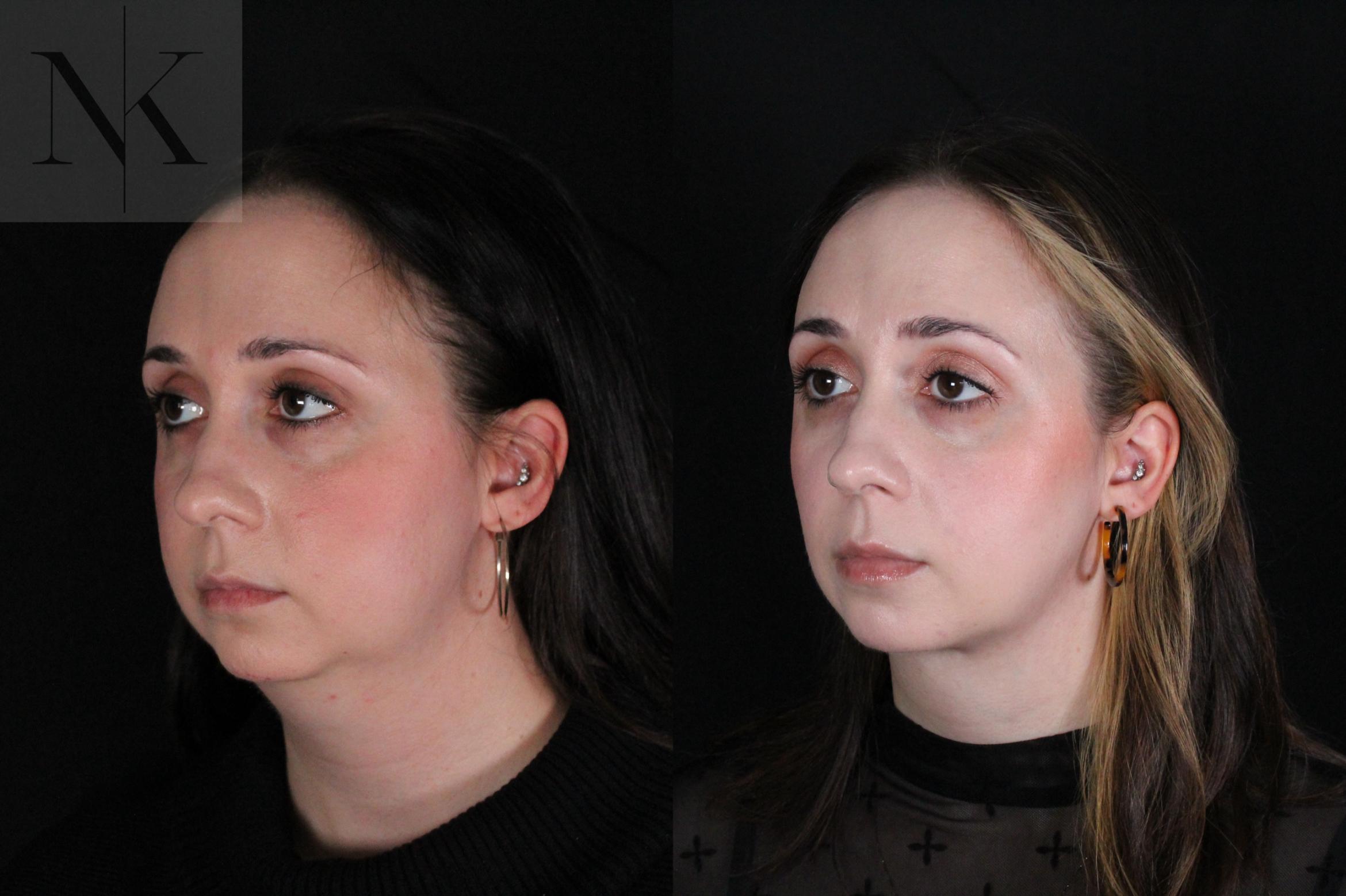 Before & After Isolated Deep Neck Lift Case 117 Left Oblique View in Wethersfield, Hartford, Nebraska