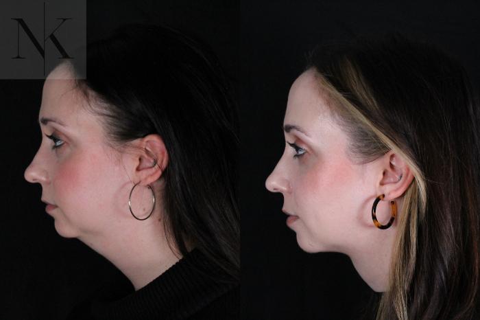 Before & After Isolated Deep Neck Lift Case 117 Left Side View in Wethersfield, Hartford, Nebraska