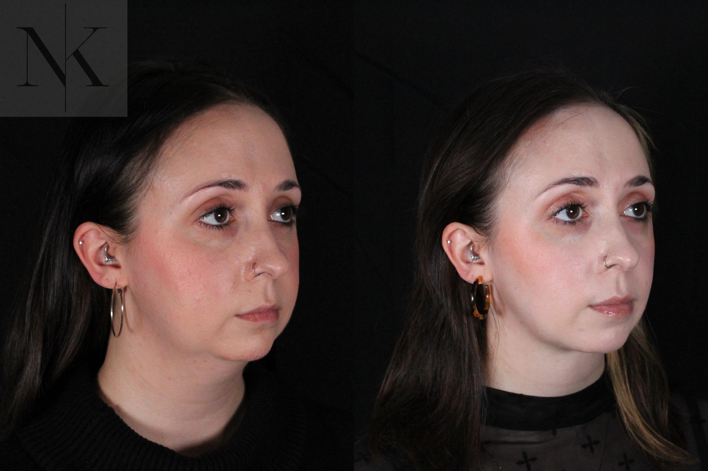 Before & After Isolated Deep Neck Lift Case 117 Right Oblique View in Wethersfield, Hartford, Nebraska