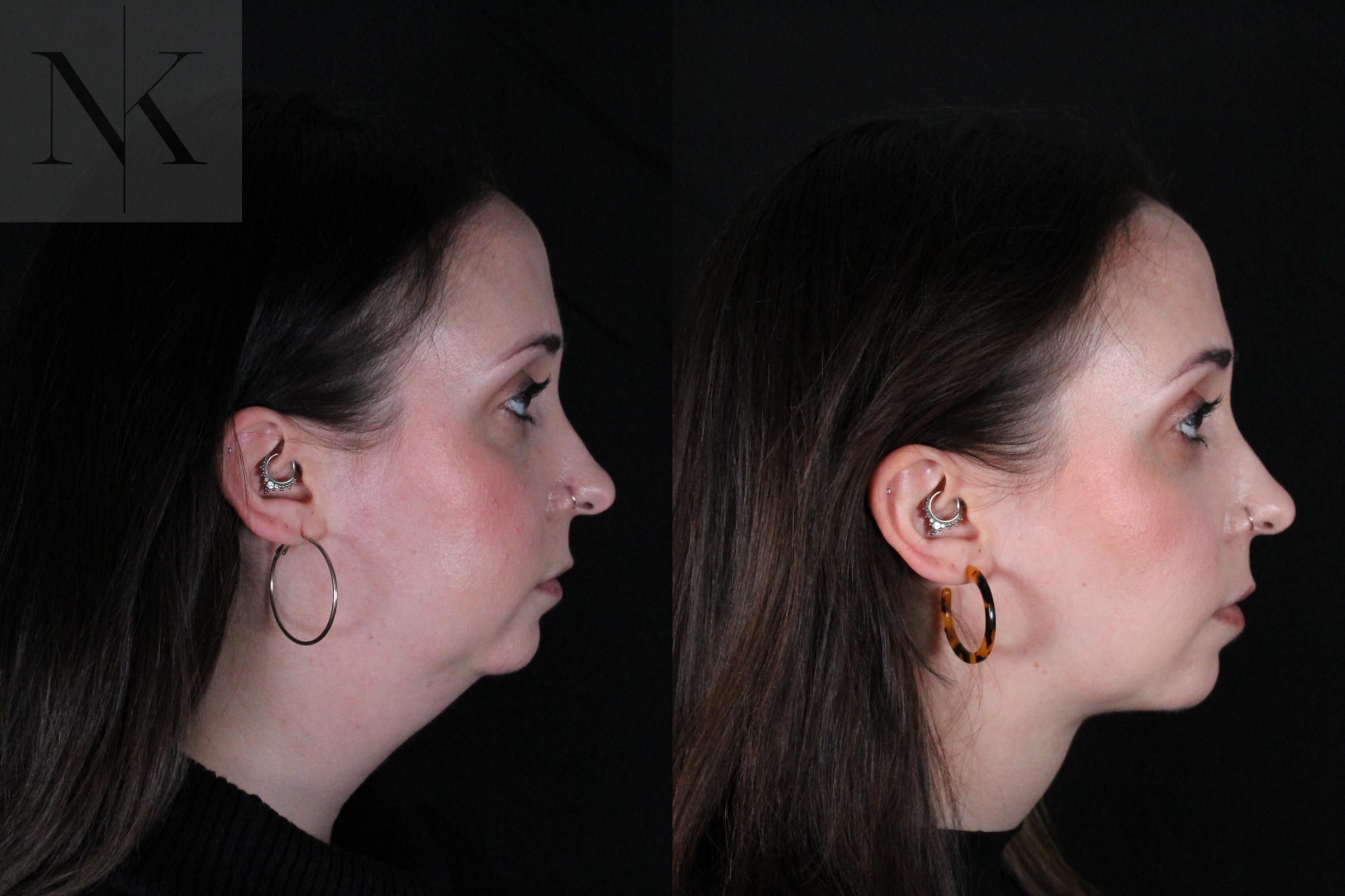 Before & After Isolated Deep Neck Lift Case 117 Right Side View in Wethersfield, Hartford, Nebraska