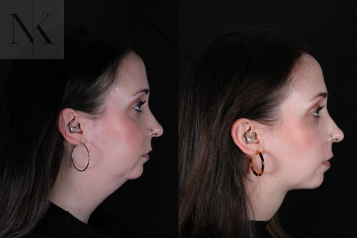 Before & After Isolated Deep Neck Lift Case 117 Right Side View in Wethersfield, Hartford, Nebraska
