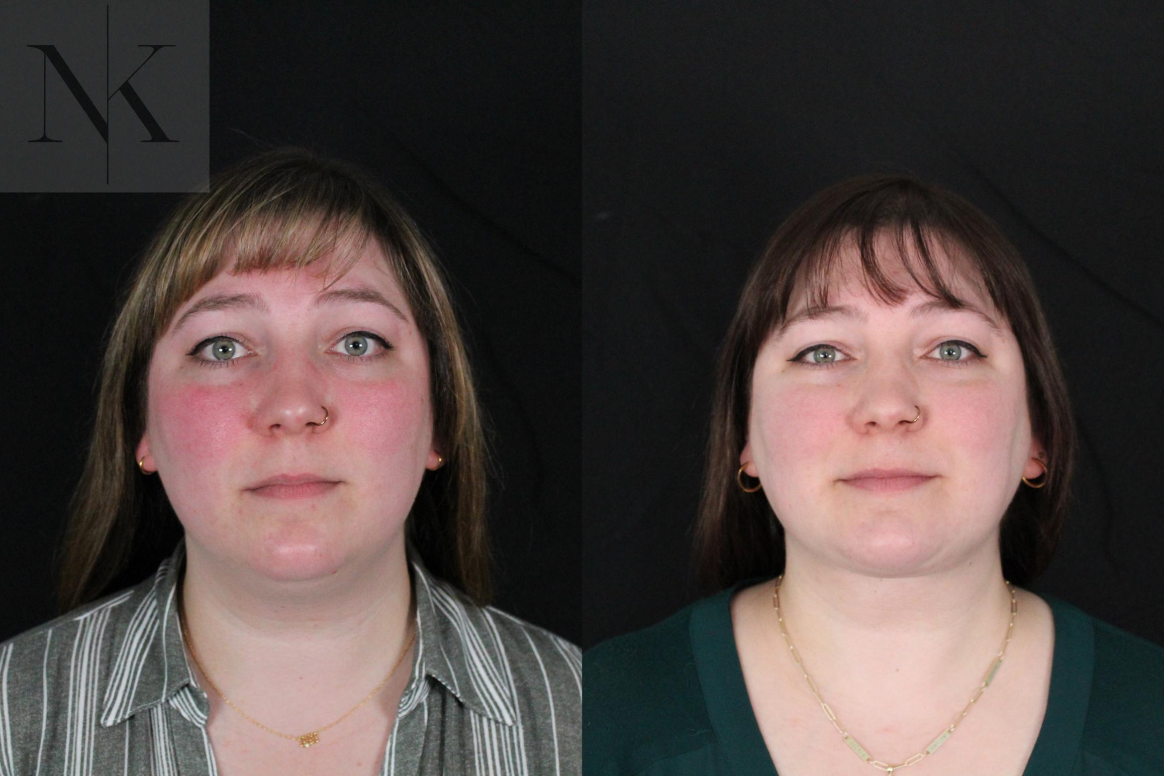 Before & After Isolated Deep Neck Lift Case 118 Front View in Wethersfield, Hartford, Nebraska