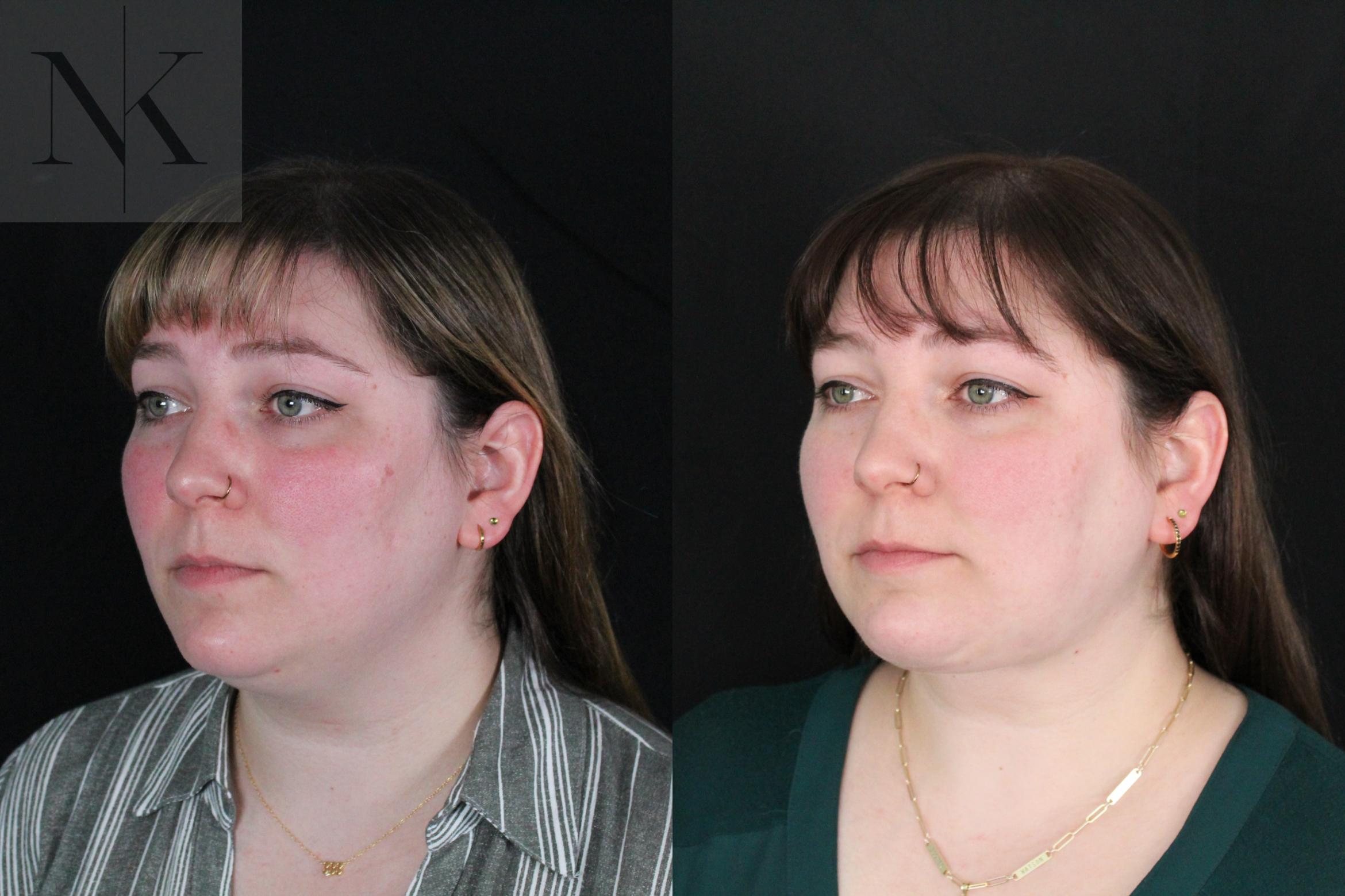 Before & After Isolated Deep Neck Lift Case 118 Left Oblique View in Wethersfield, Hartford, Nebraska