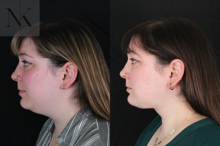 Before & After Isolated Deep Neck Lift Case 118 Left Side View in Wethersfield, Hartford, Nebraska