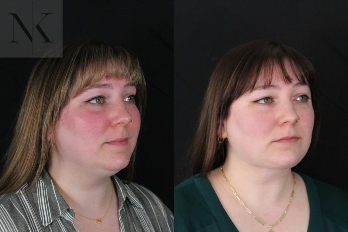 Before & After Isolated Deep Neck Lift Case 118 Right Oblique View in Wethersfield, Hartford, Nebraska