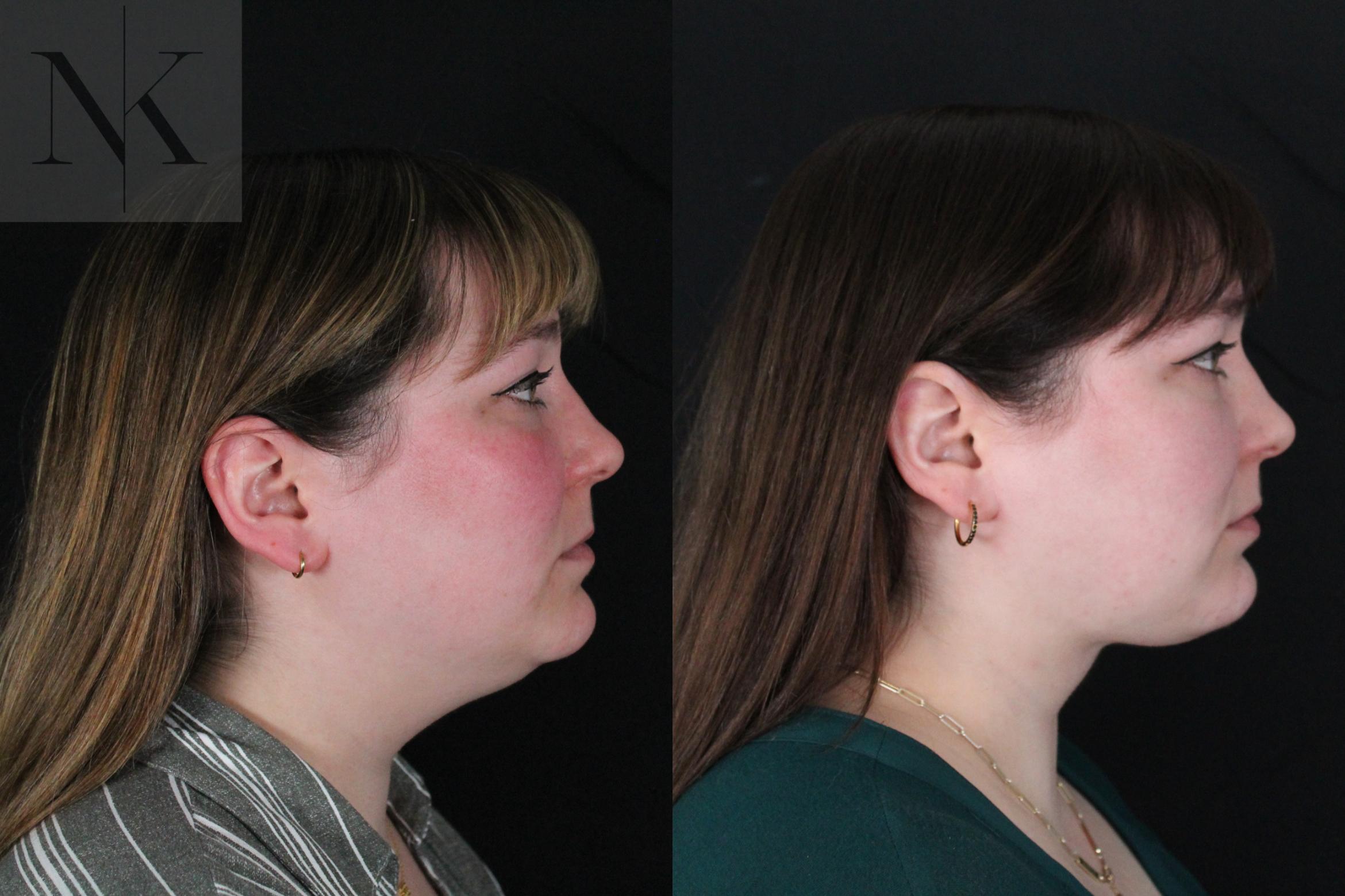 Before & After Isolated Deep Neck Lift Case 118 Right Side View in Wethersfield, Hartford, Nebraska