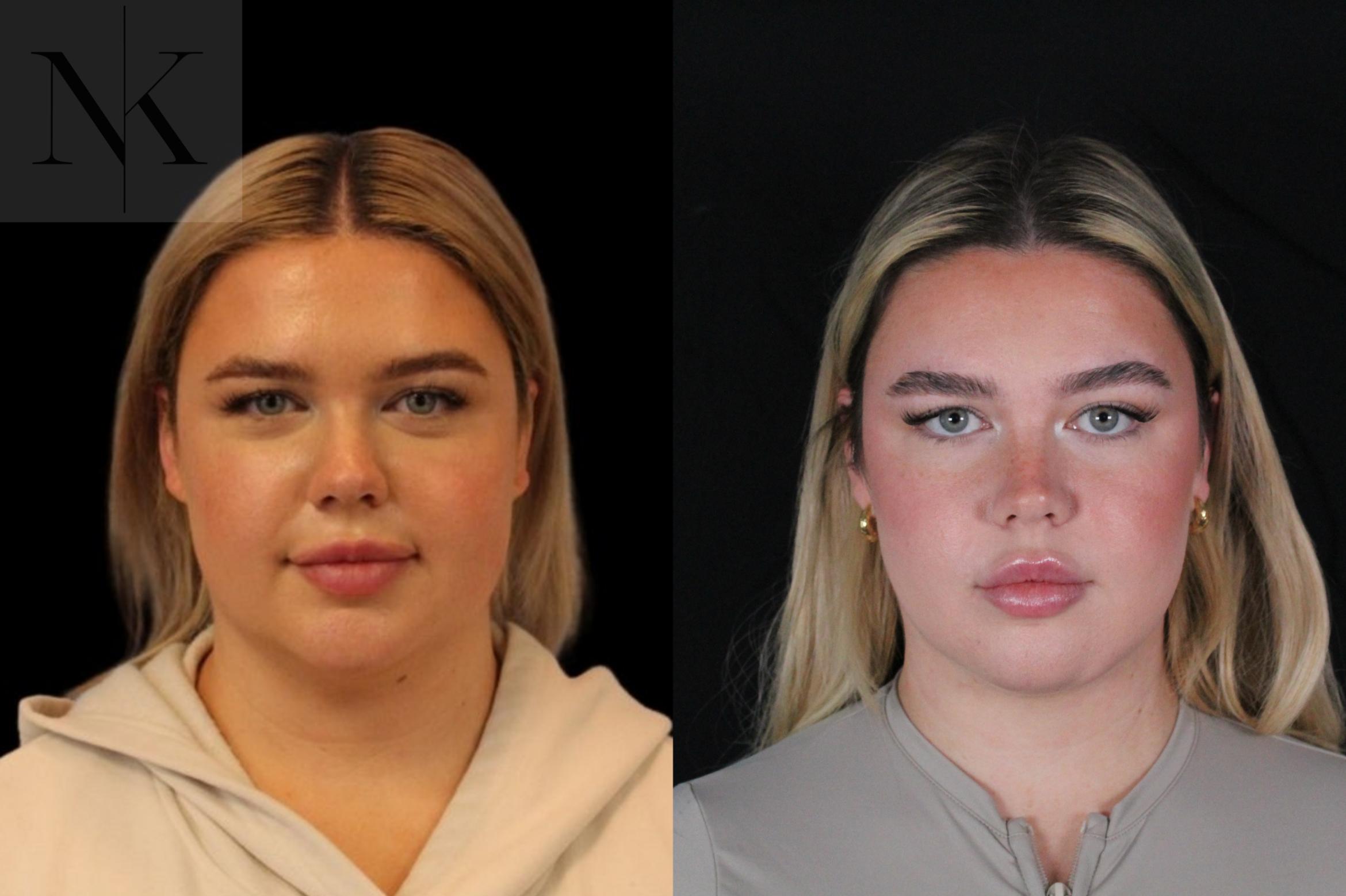 Before & After Isolated Deep Neck Lift Case 119 Front View in Wethersfield, Hartford, Nebraska