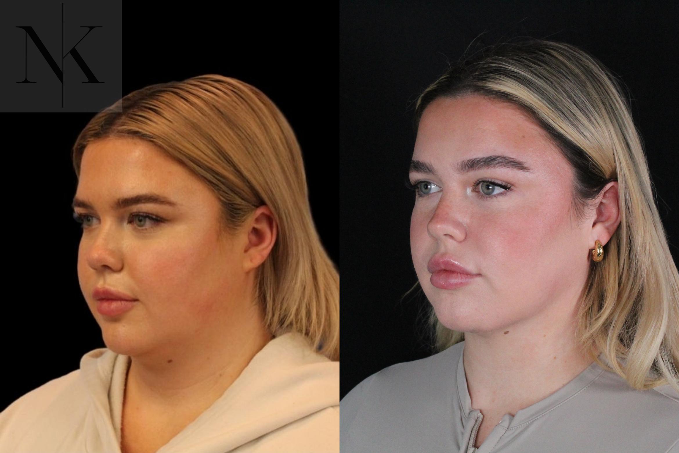 Before & After Isolated Deep Neck Lift Case 119 Left Oblique View in Wethersfield, Hartford, Nebraska