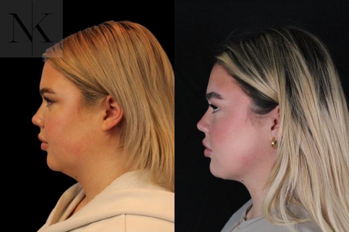 Before & After Isolated Deep Neck Lift Case 119 Left Side View in Wethersfield, Hartford, Nebraska
