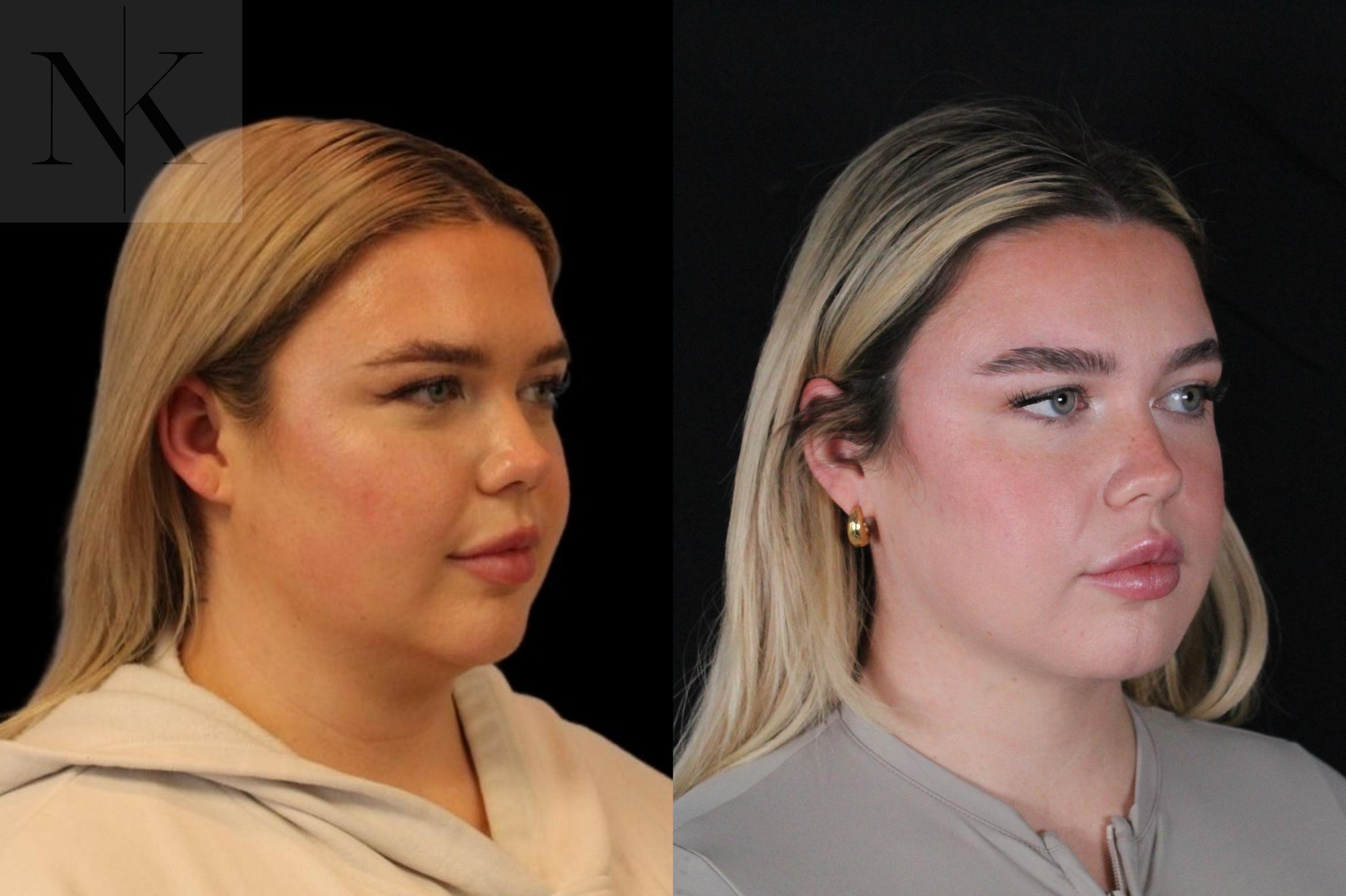 Before & After Isolated Deep Neck Lift Case 119 Right Oblique View in Wethersfield, Hartford, Nebraska