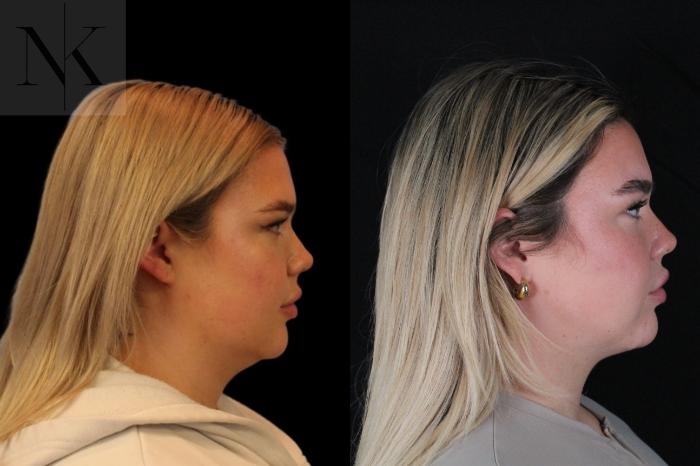 Before & After Isolated Deep Neck Lift Case 119 Right Side View in Wethersfield, Hartford, Nebraska