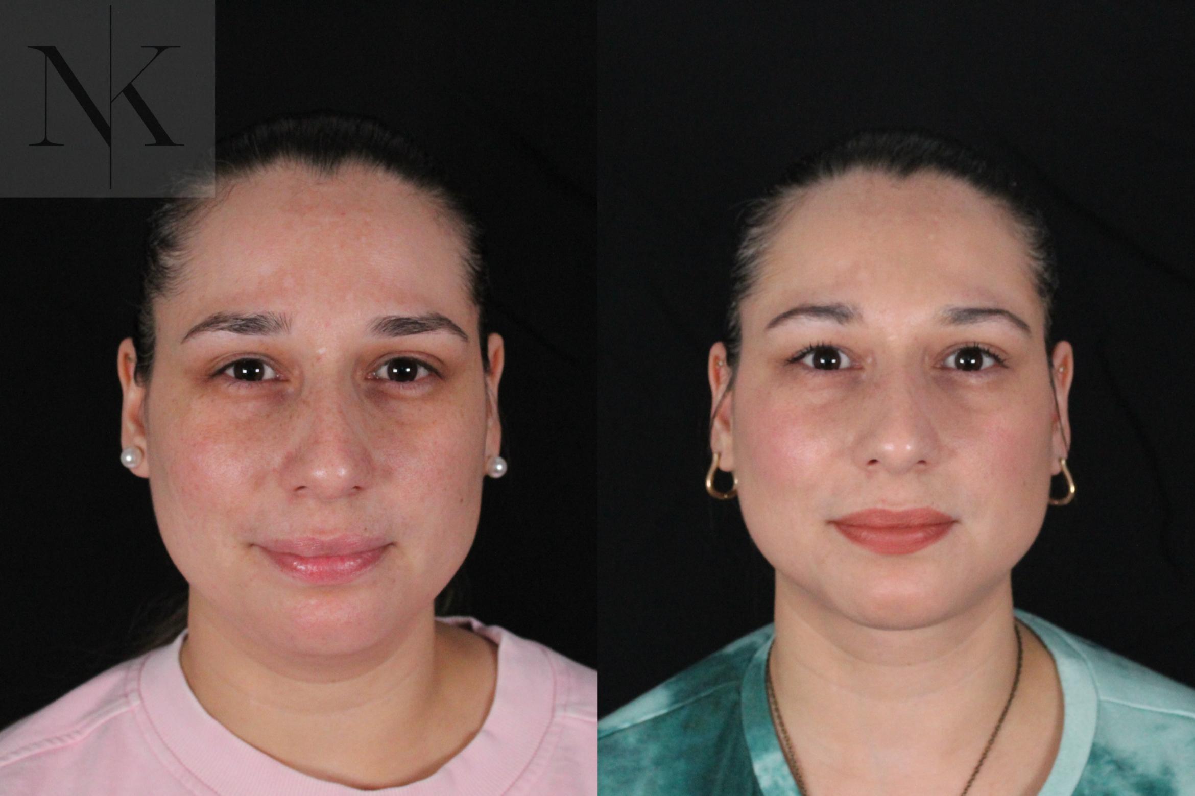 Before & After Isolated Deep Neck Lift Case 120 Front View in Wethersfield, Hartford, Nebraska
