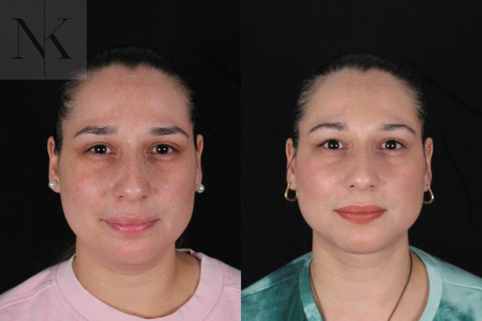 Before & After Isolated Deep Neck Lift Case 120 Front View in Wethersfield, Hartford, Nebraska
