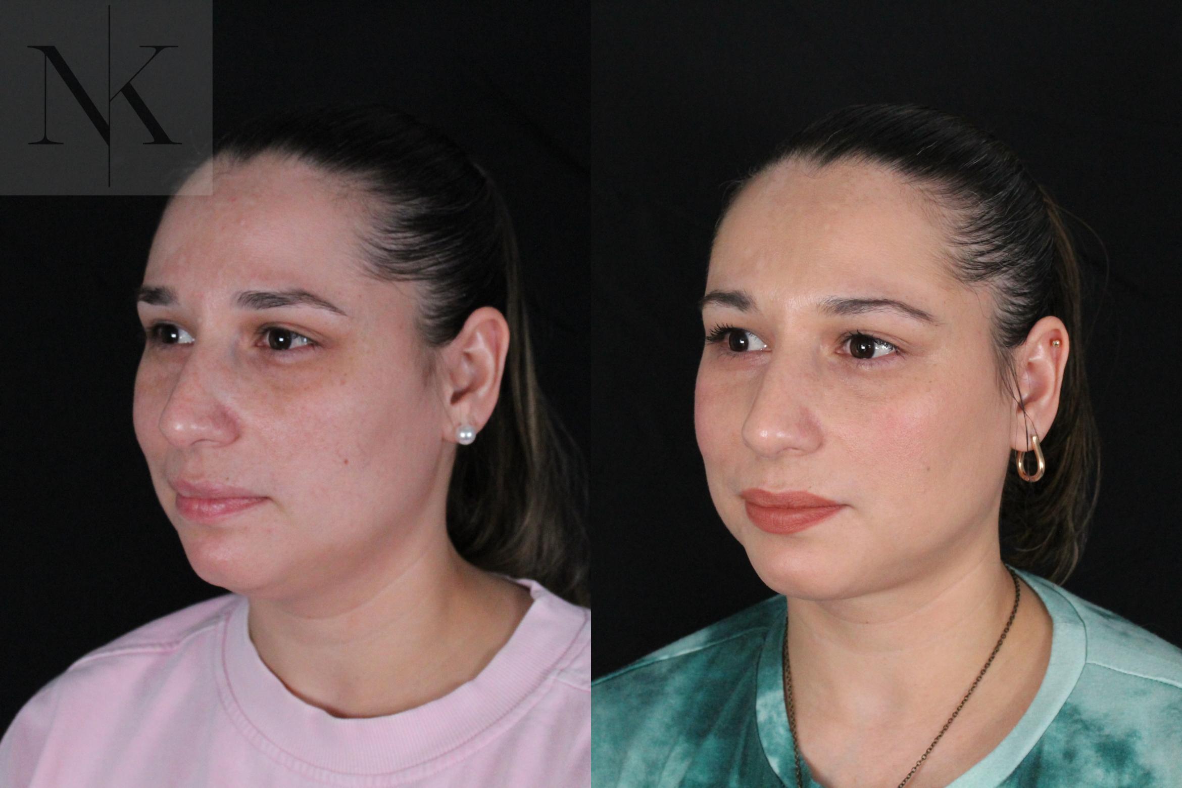Before & After Isolated Deep Neck Lift Case 120 Left Oblique View in Wethersfield, Hartford, Nebraska