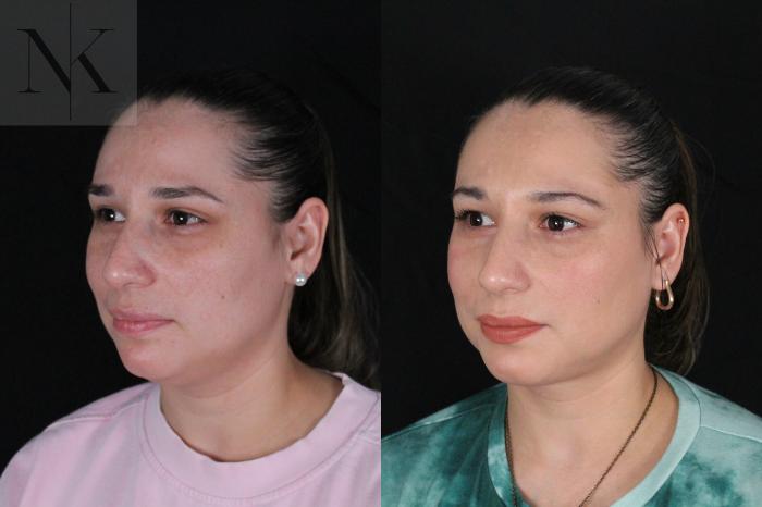 Before & After Isolated Deep Neck Lift Case 120 Left Oblique View in Wethersfield, Hartford, Nebraska