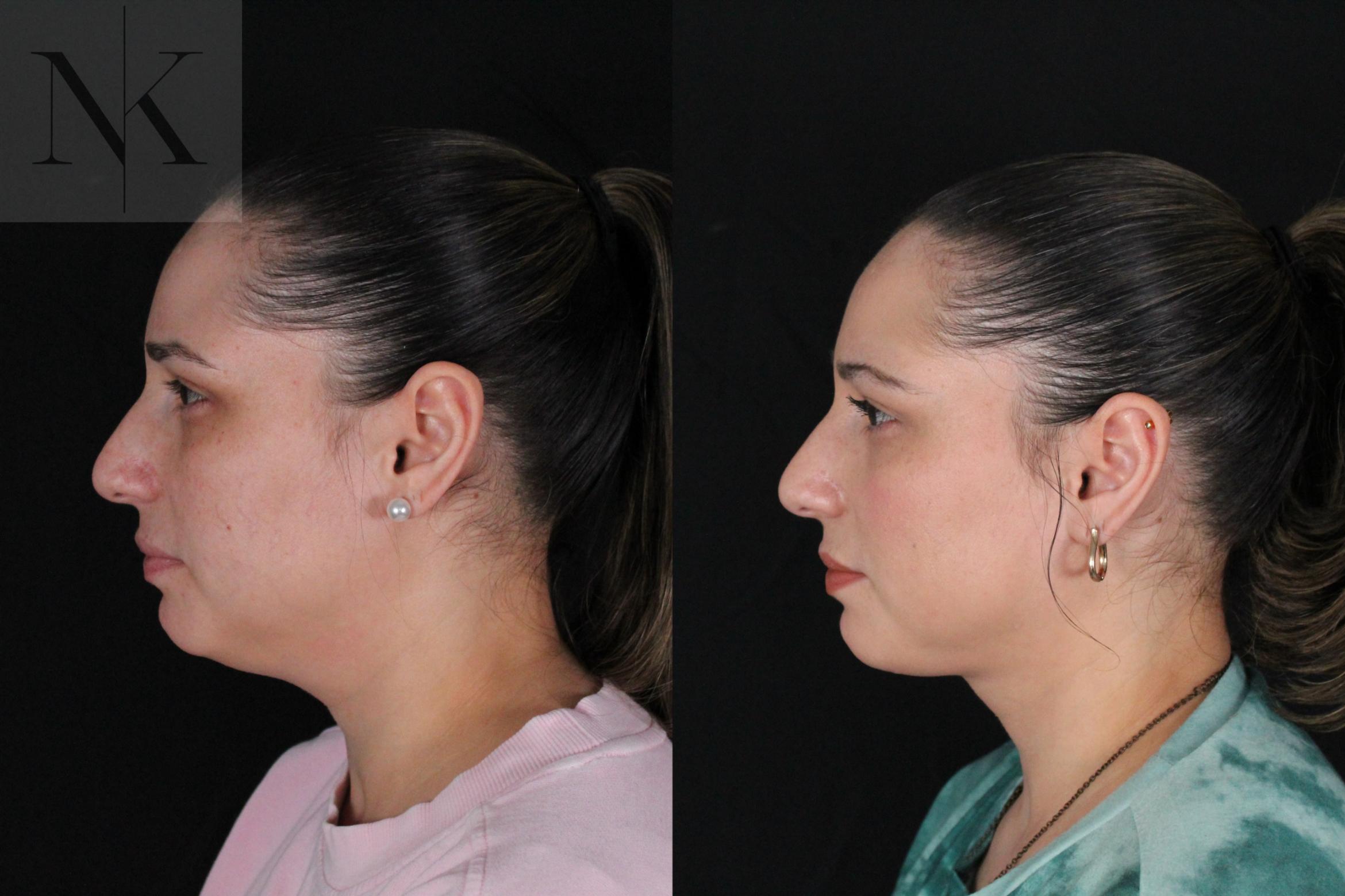 Before & After Isolated Deep Neck Lift Case 120 Left Side View in Wethersfield, Hartford, Nebraska