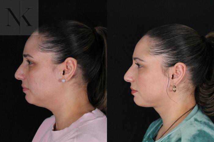 Before & After Isolated Deep Neck Lift Case 120 Left Side View in Wethersfield, Hartford, Nebraska