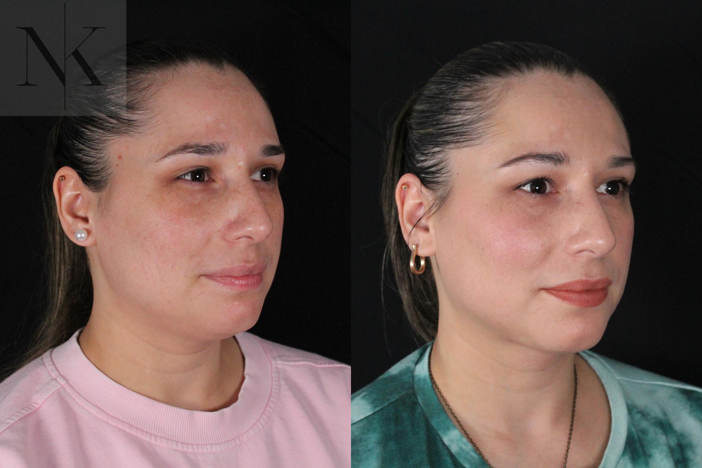 Before & After Isolated Deep Neck Lift Case 120 Right Oblique View in Wethersfield, Hartford, Nebraska